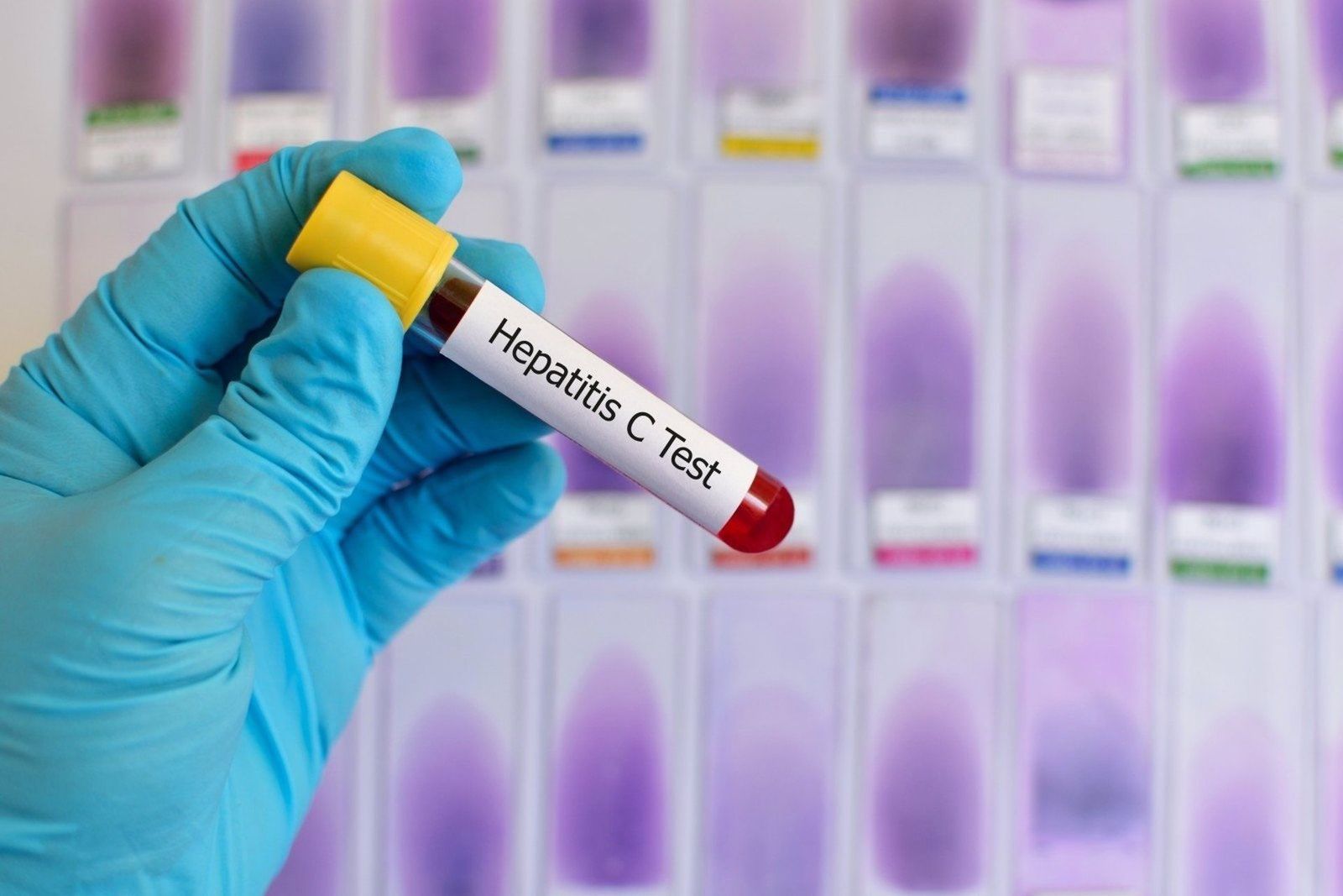 Hepatitis C. Hepatitis C.