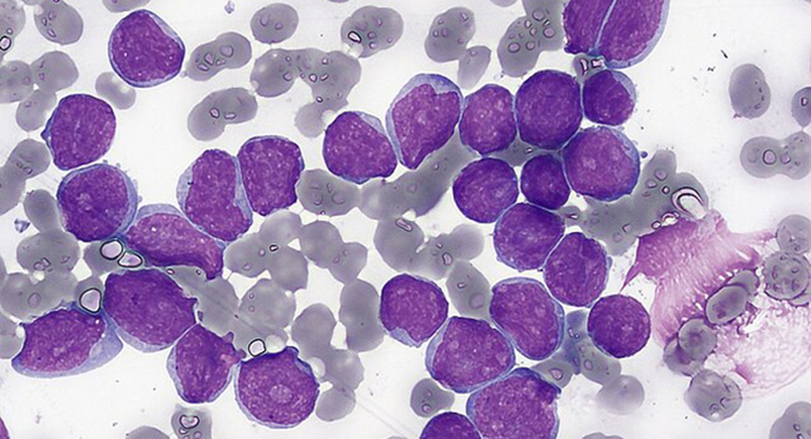 Investigadores del CIC participan en un proyecto internacional para identificar biomarcadores epigenéticos que detecten precozmente el riesgo de leucemia infantil Investigadores del CIC participan en un proyecto internacional para identificar biomarcadores epigenéticos que detecten precozmente el riesgo de leucemia infantil
