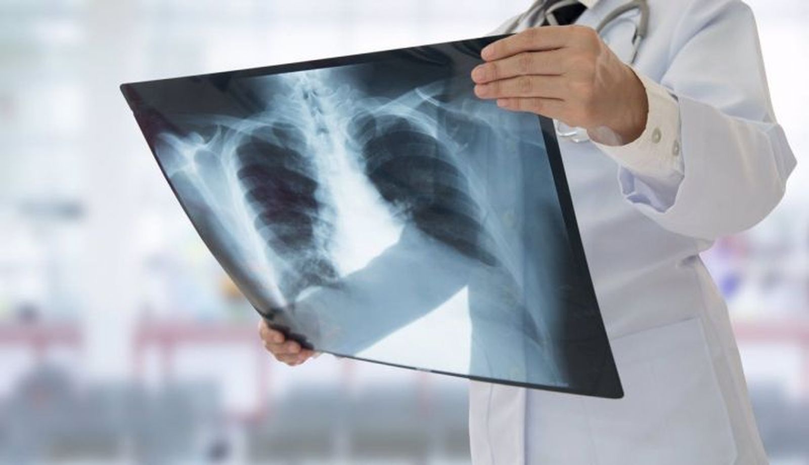 Cáncer de pulmón| EP 