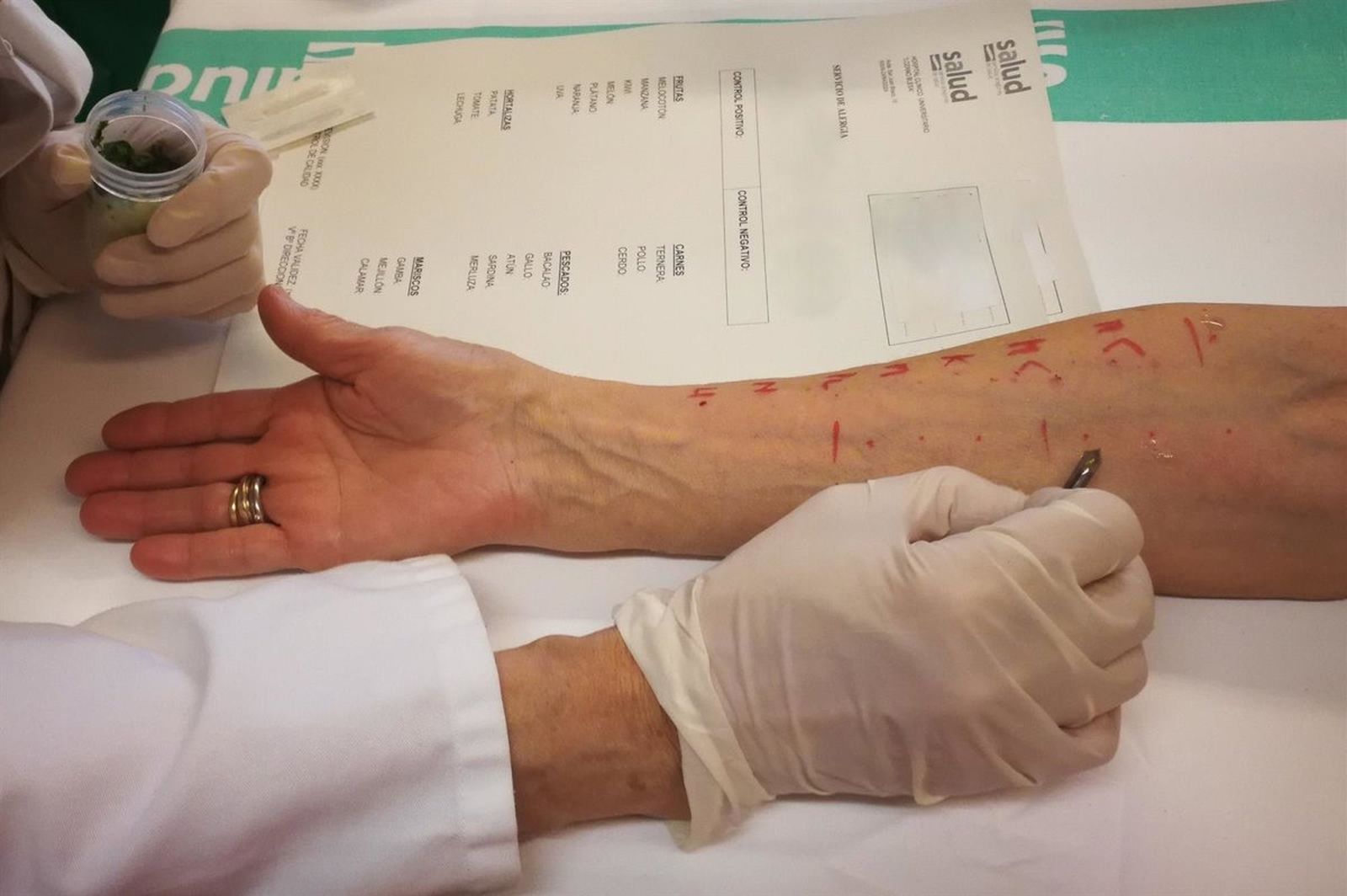 Pruebas de alergia EP